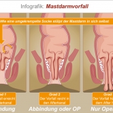 Mastdarmvorfall
